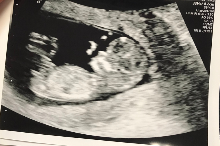 Courtney B., 29 | Conceiving with PCOS in One Cycle