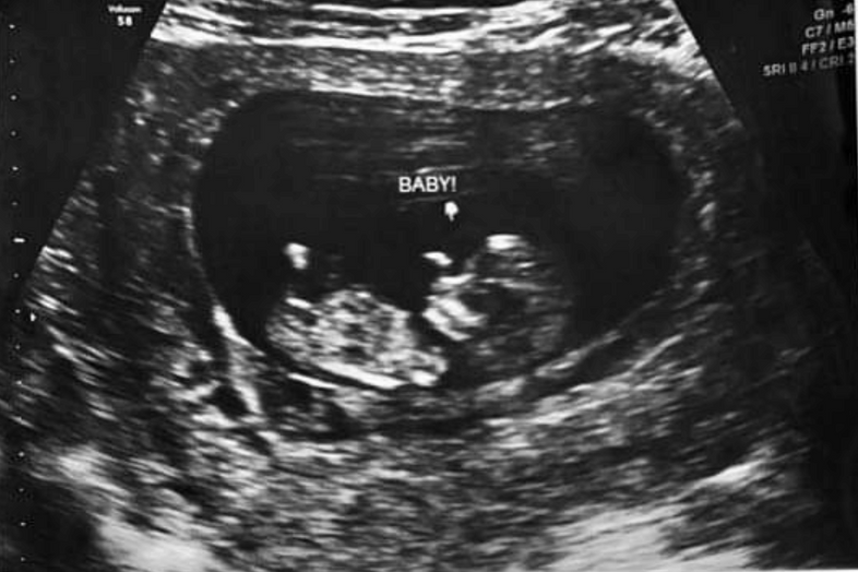 Heather F. | Conceiving Naturally After Years of Fertility Struggles with PCOS