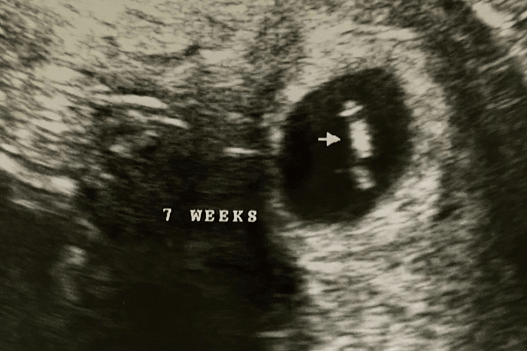 Lindsey F. | Conceiving with PCOS After Years of Struggling