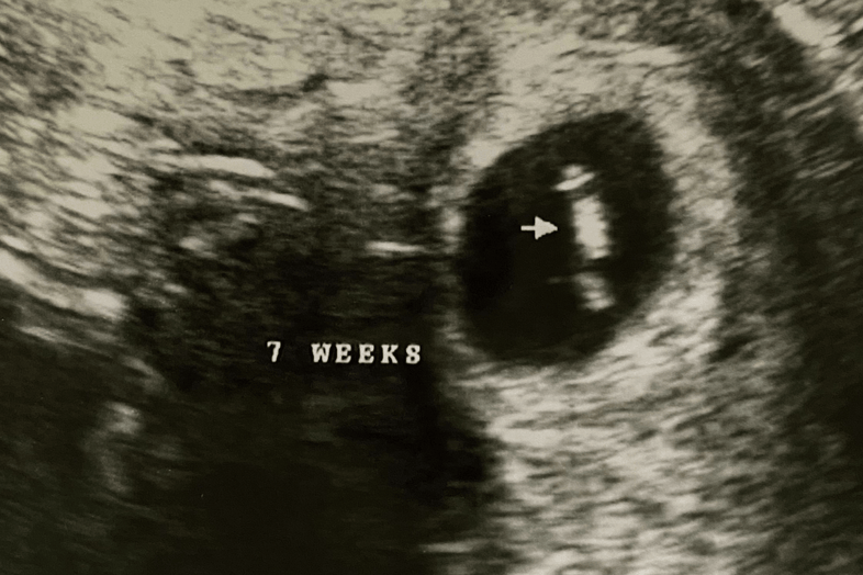 Lindsey F. | Conceiving with PCOS After Years of Struggling