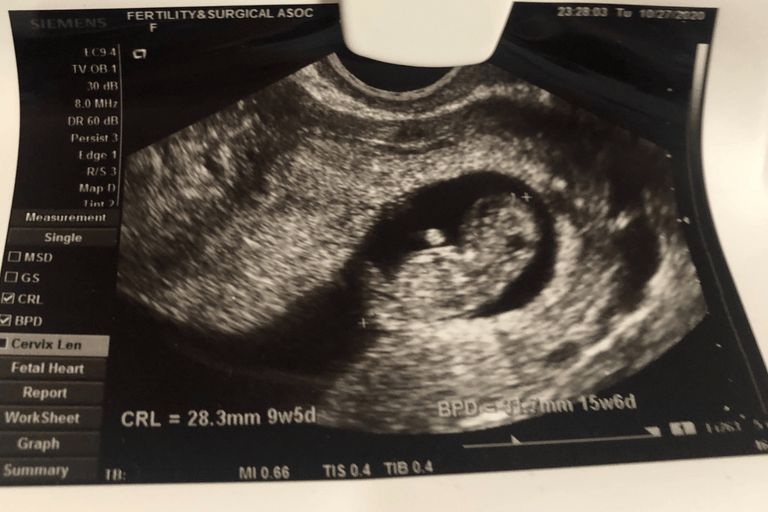 Ashley K., 32 | Conceiving After Years of Struggling with Irregular Cycles