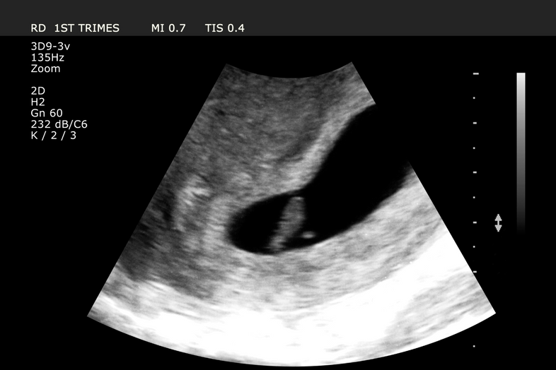 Nickelle | Pregnant After 8 Years of Trying